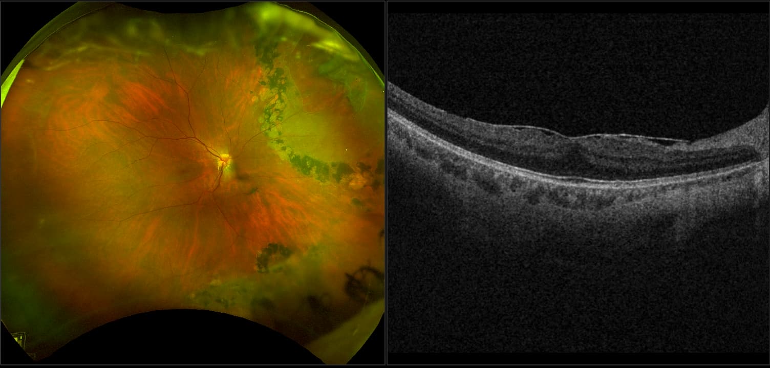 side by side retina comparison