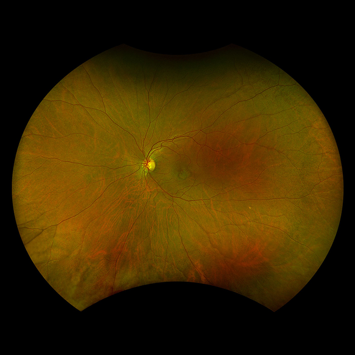 optomap couleur rg